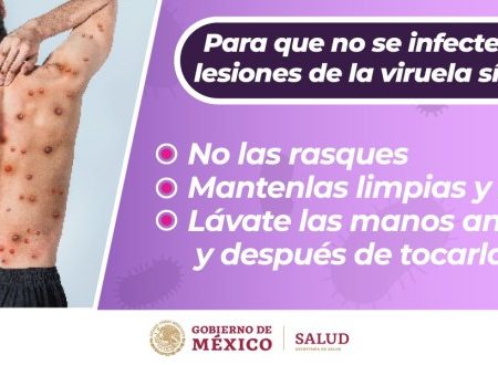 Disminuye en México curva epidémica de viruela símica, informa Secretaría de Salud